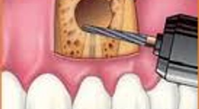 Wurzelspitzenresektion