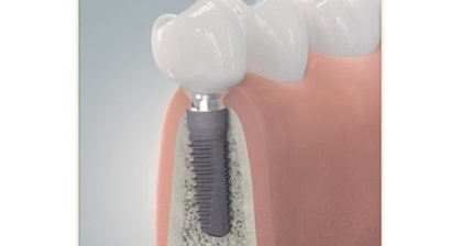 Zahnimplantate