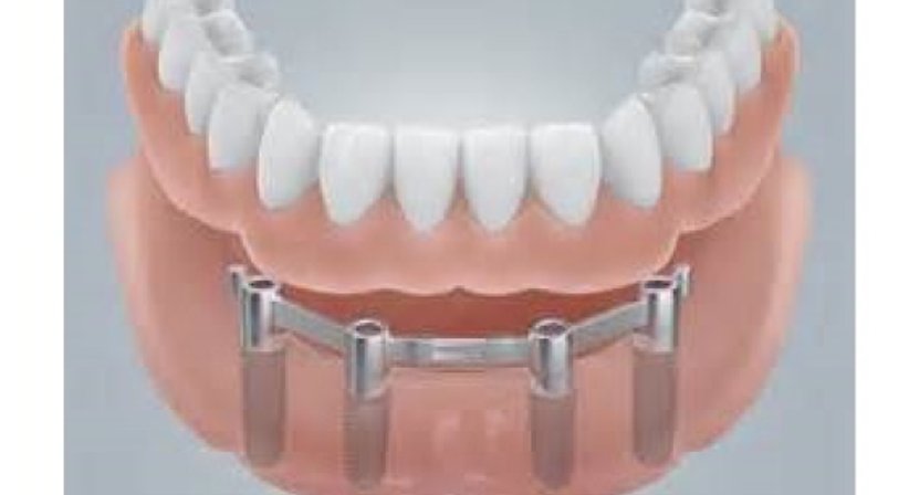 Zahnimplantate - DDr. Barbara Ferra - Zahnärztin Graz 8010