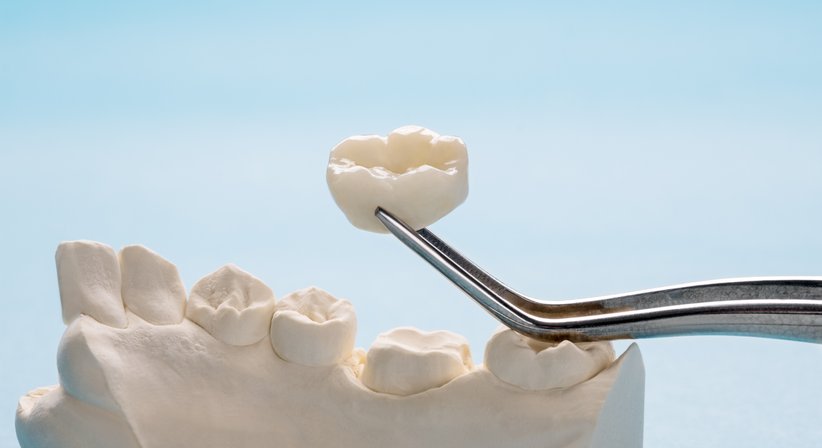 Kronen- und Brückenversorgung - Dr. med. dent. Arnold Bobb - Zahnarzt Wien 1020