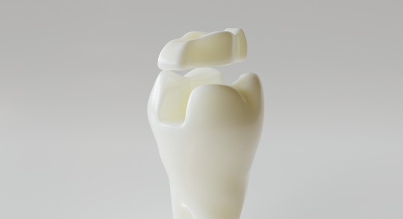 Keramikinlays - Dr. med. dent. Arnold Bobb - Zahnarzt Wien 1020