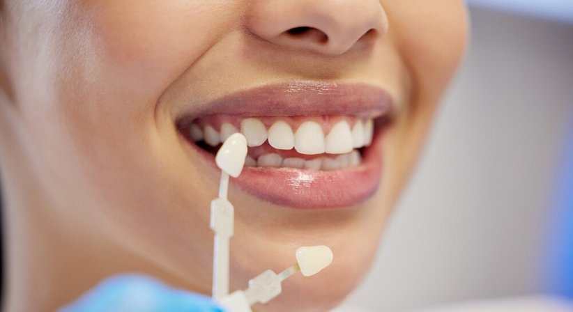 Veneers - Dr. med. dent. Arnold Bobb - Zahnarzt Wien 1020