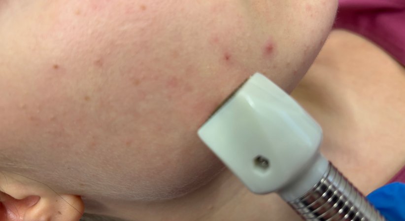 Radiofrequenz Microneedling - Dr. Martina Sandhofer - Hautärztin Linz 4040