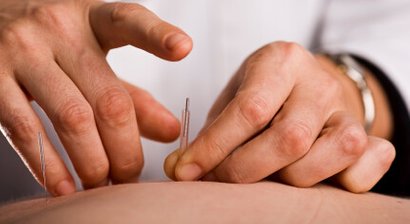 Akupunktur