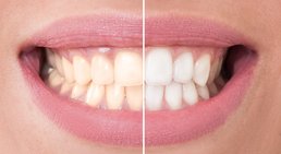 Bleaching -