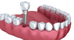 Implantologie -