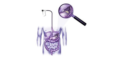 Sanfte Gastroskopie (Magenspiegelung)