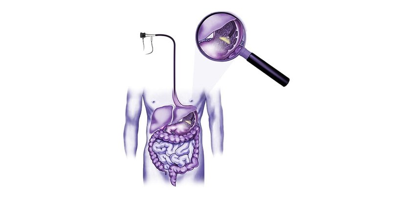 Sanfte Gastroskopie (Magenspiegelung) - Prof.Dr. Michael Rogy - Allgemeinchirurg Wien 1020