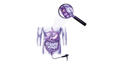 Sanfte Koloskopie (Darmspiegelung)