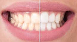 Bleaching -