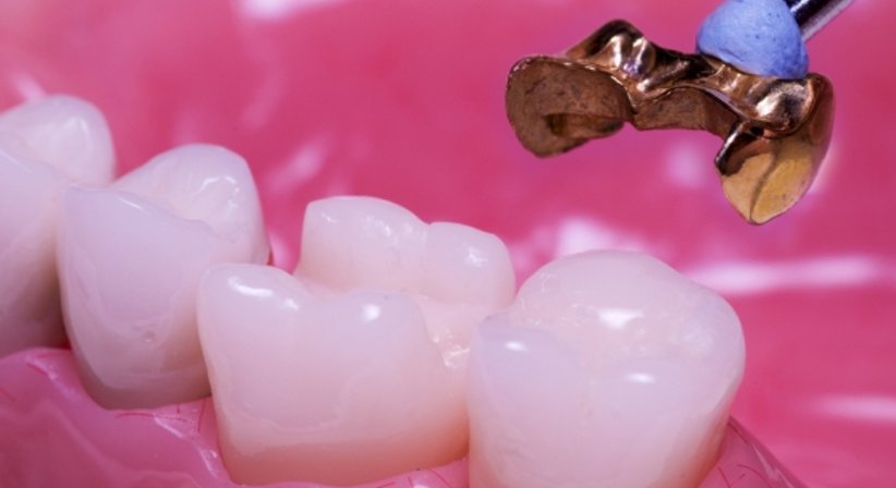 Kronen (Zahnersatz aus Vollkeramik) - Dr. Behfar Basharat - Zahnarzt Wien 1150