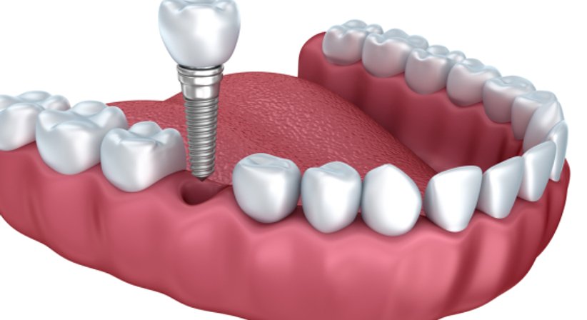 Zahnimplantate - Dr. Behfar Basharat - Zahnarzt Wien 1150