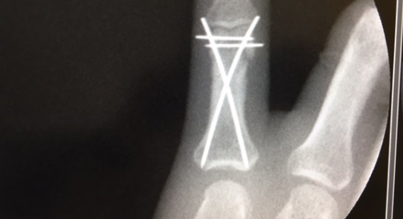 Osteosynthesen - OA Dr. Andreas Mondl - Unfallchirurg Wien 1220