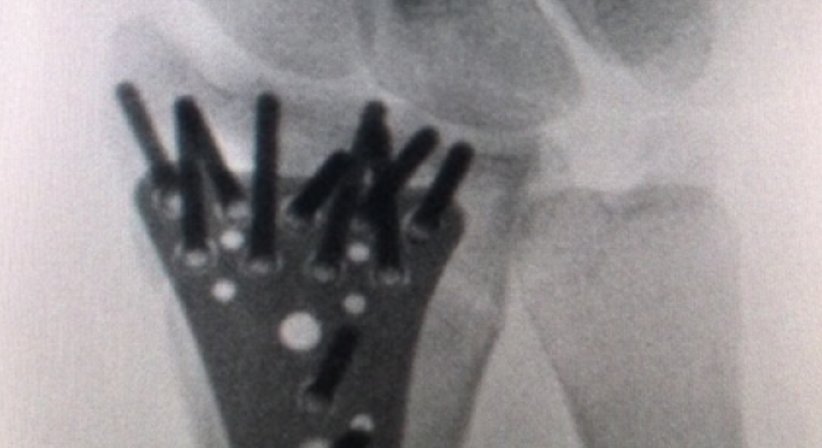 Osteosynthesen - OA Dr. Andreas Mondl - Unfallchirurg Wien 1220