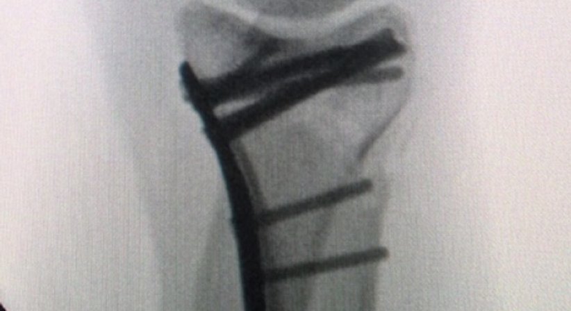 Osteosynthesen - OA Dr. Andreas Mondl - Unfallchirurg Wien 1220