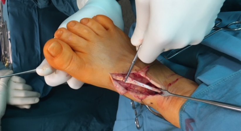 Sehnenchirugie - OA Dr. Andreas Mondl - Unfallchirurg Wien 1220