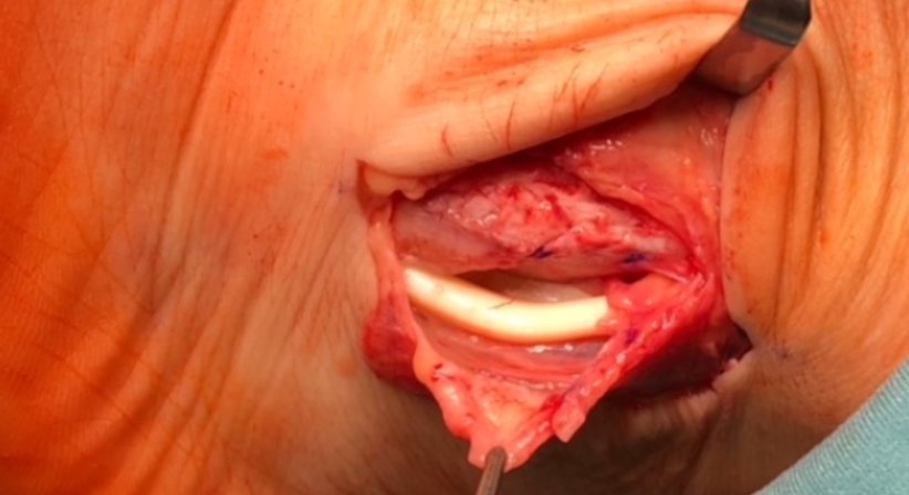 Sehnenchirugie - OA Dr. Andreas Mondl - Unfallchirurg Wien 1220