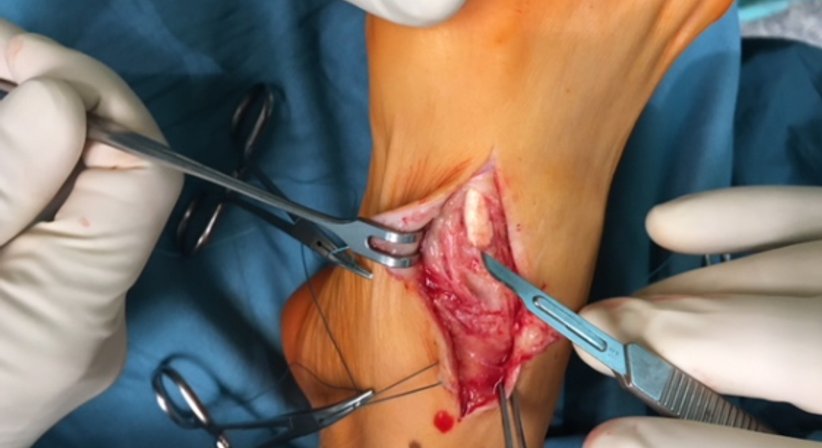 Sehnenchirugie - OA Dr. Andreas Mondl - Unfallchirurg Wien 1220