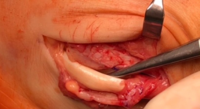 Sehnenchirugie - OA Dr. Andreas Mondl - Unfallchirurg Wien 1220