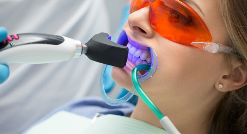 Bleaching - Dr. Bruno Lichtner - Zahnarzt Wien 1030