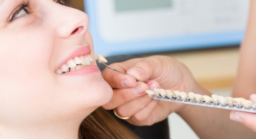 Veneers - Dr. Bruno Lichtner - Zahnarzt Wien 1030