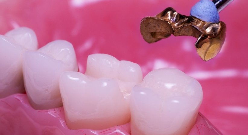 Kronen / Brücken - DDr. Wolfgang Seemann - Zahnarzt Wien 1150