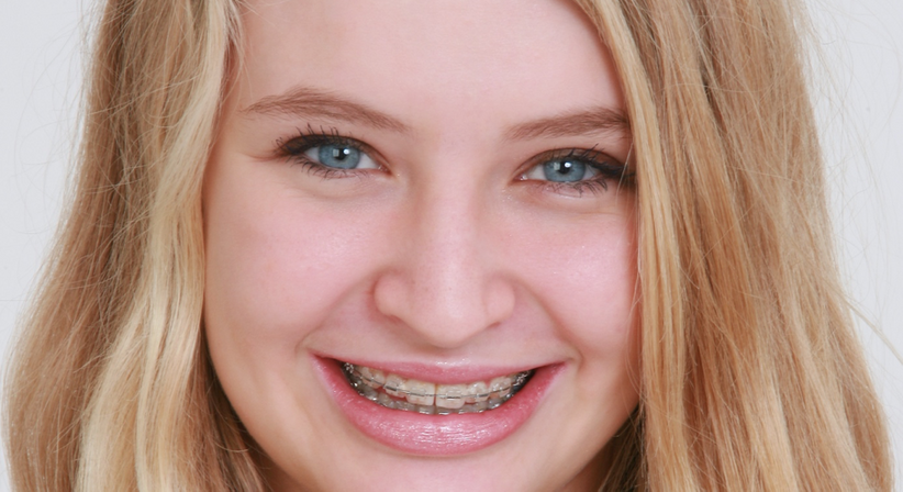 Festsitzende Zahnspangen - Dr. Monika Semelmayer - Zahnärztin Wien 1080