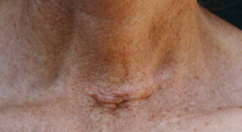 Schilddrüsenkrebs - Dr. Siegfried Bachmayr - Nuklearmediziner Wien 1130