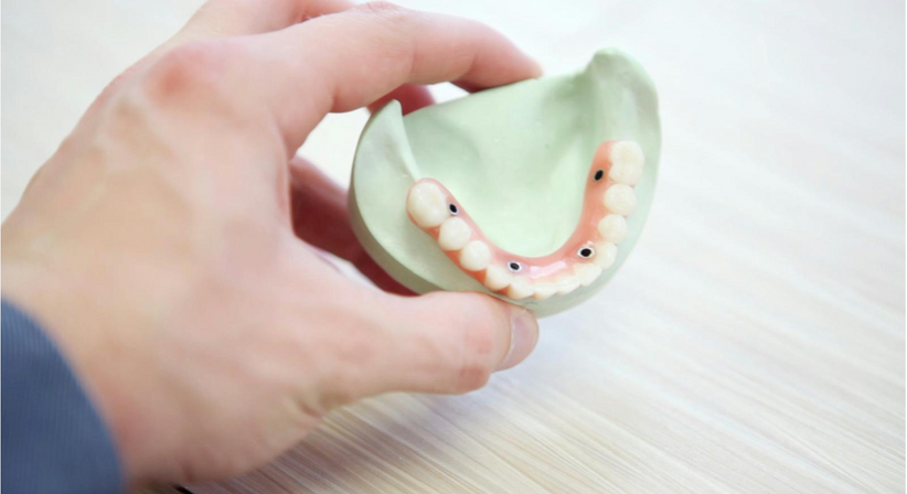 All-on-4 / All-on-6 Versorgung - Dr. Sarah Abdel-Hamied - Zahnärztin Gänserndorf 2230