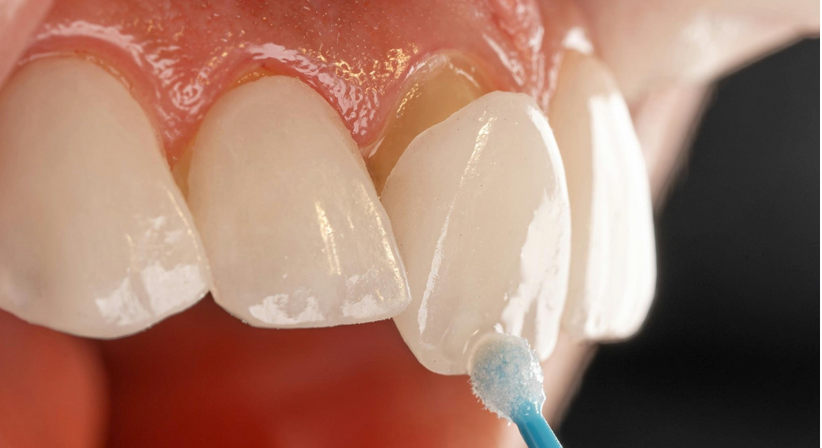 Ästhetische Zahnheilkunde (Veneers, Inlays, Onlay, Overlays, Zahnkronen und Brücken) - Dr. Sarah Abdel-Hamied - Zahnärztin Gänserndorf 2230