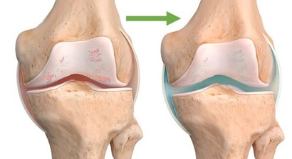 Hyaluronsäure – Knorpeltherapie bei Arthrose und Gelenkentzündung
