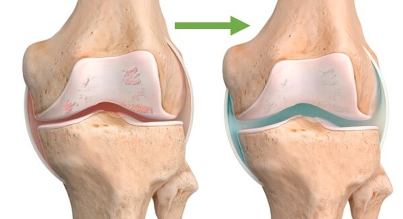 Hyaluronsäure – Knorpeltherapie bei Arthrose und Gelenkentzündung bei OA Priv.-Doz. Dr.  Wenzel Waldstein-Wartenberg