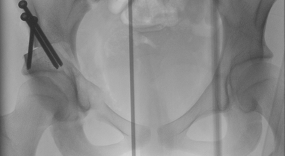 Beckenosteotomie bei Hüftdysplasie (Stellungskorrektur der Hüftpfanne), PAO (periazetabuläre Osteotomie)
