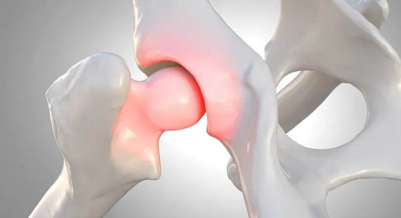 Beckenosteotomie bei Hüftdysplasie (Stellungskorrektur der Hüftpfanne), PAO (periazetabuläre Osteotomie) - Dr. med. Wolfgang Zinser, Prim. a. D. - Orthopäde Knittelfeld 8720