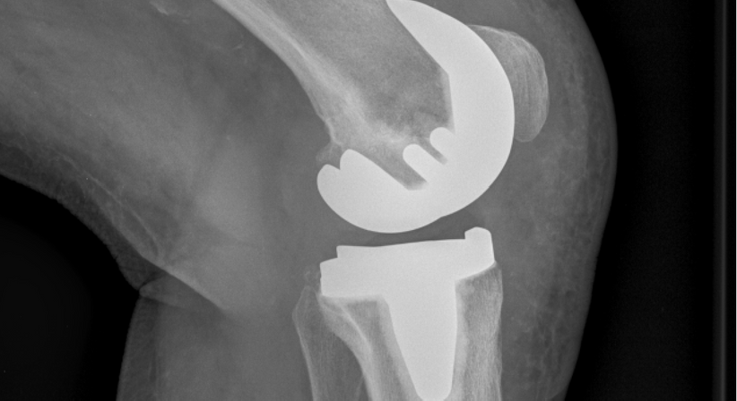Knieprothese (Kniegelenkersatz) - Dr. med. Wolfgang Zinser, Prim. a. D. - Orthopäde Knittelfeld 8720