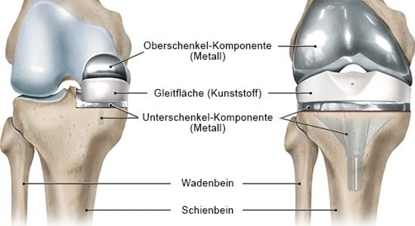 Knieprothese (Kniegelenkersatz) - Dr. med. Wolfgang Zinser, Prim. a. D. - Orthopäde Knittelfeld 8720