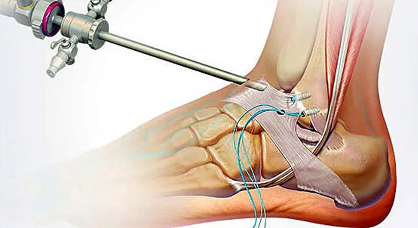 Arthroskopie des Sprunggelenks - Dr. med. Wolfgang Zinser, Prim. a. D. - Orthopäde Knittelfeld 8720