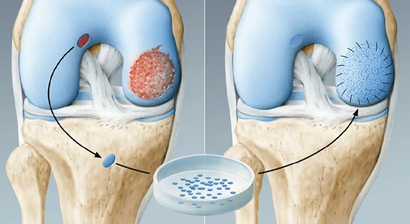 Chirurgische Knorpeltherapie / Knorpelzelltransplantation