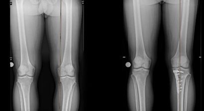 Beinachsenkorrektur bei X- und O-Bein Fehlstellungen