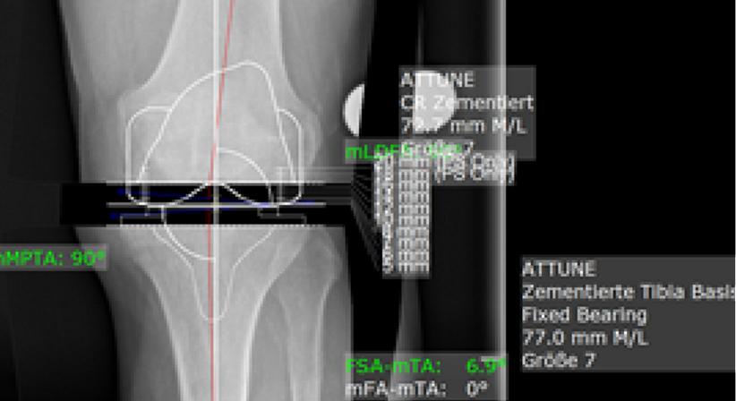 Knieprothese (Kniegelenkersatz) - Dr. med. Wolfgang Zinser, Prim. a. D. - Orthopäde Knittelfeld 8720