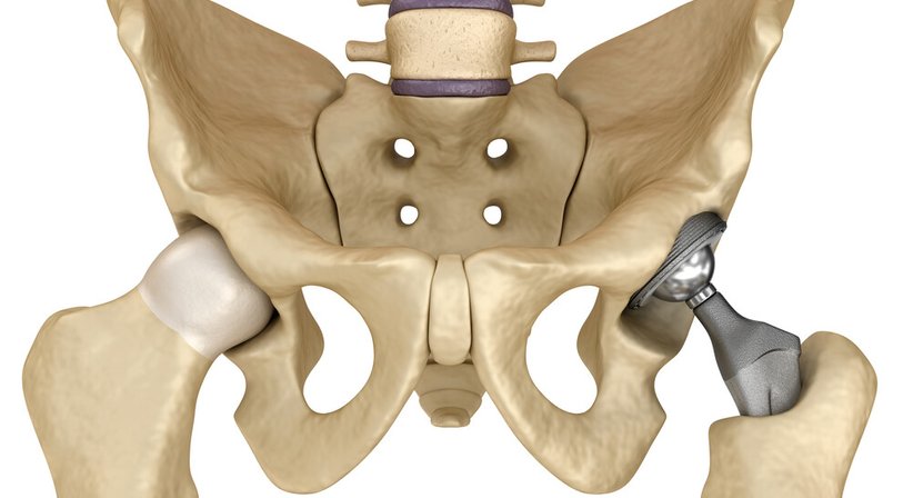 Künstliches Hüftgelenk - OA Dr. Patrick Niederle - Orthopäde Rannersdorf bei Schwechat 2320