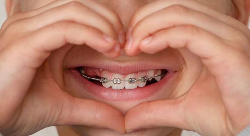 Selbstligierende Zahnspange - Dr. med. dent. Hadi Dehghani, MSc - Schwerpunkt: Kieferorthopädie Pfarrwerfen 5452