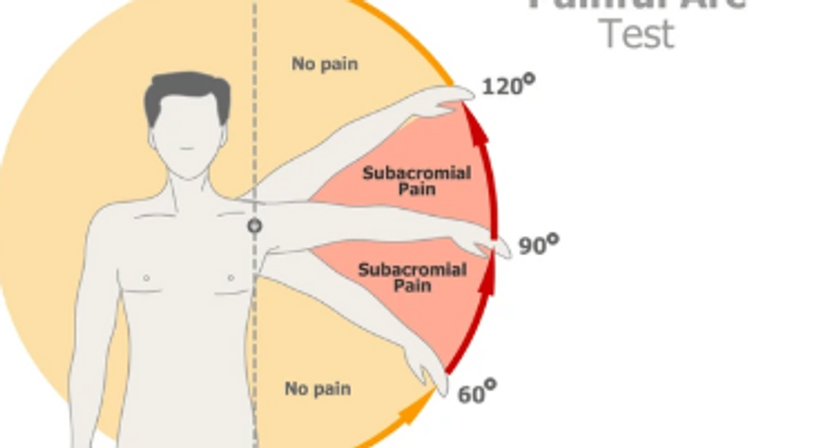 Impingement Syndrom, Kalkschulter - OA Ing. Dr. med. Benjamin Schett - Orthopäde Wien 1010