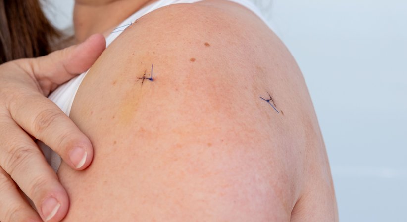 Schulter Arthroskopie - OA Ing. Dr. med. Benjamin Schett - Orthopäde Wien 1010