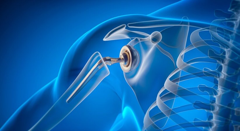 Arthrose (Schulter- TEP inkl. Revisionsendoprothetik) - OA Ing. Dr. med. Benjamin Schett - Orthopäde Wien 1010