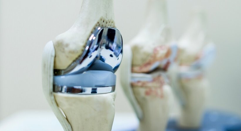 Arthrose (Halbschlitten, Knie TEP) - OA Ing. Dr. med. Benjamin Schett - Orthopäde Wien 1010