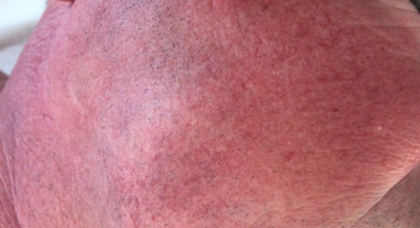 Couperose, Gefäße und Besenreiser - Dr. Kaan Harmankaya - Hautarzt Wien 1010