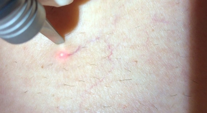 Couperose, Gefäße und Besenreiser - Dr. Kaan Harmankaya - Hautarzt Wien 1010