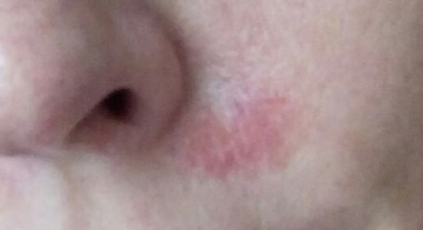 Couperose, Gefäße und Besenreiser - Dr. Kaan Harmankaya - Hautarzt Wien 1010