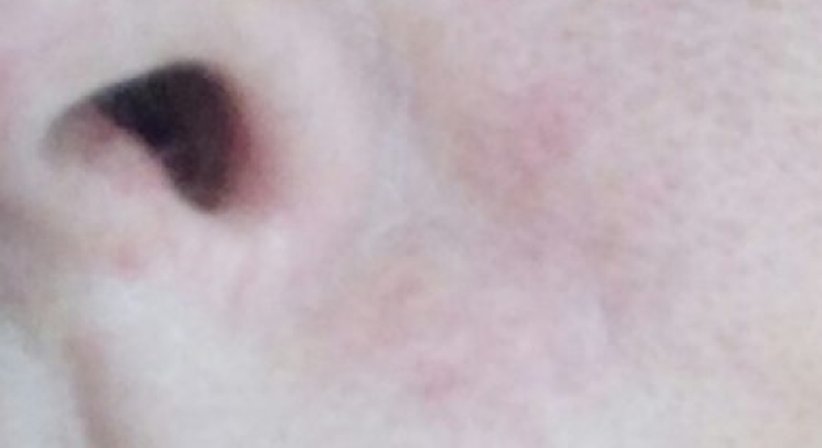 Couperose, Gefäße und Besenreiser - Dr. Kaan Harmankaya - Hautarzt Wien 1010